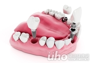改善假牙壓痛　「義齒」搞定！