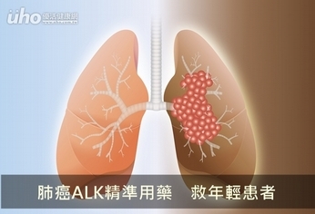肺癌ALK精準用藥　救年輕患者