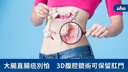 大腸直腸癌別怕　3D腹腔鏡術可保留肛門