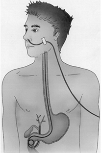 ercp术插鼻胆管图图片