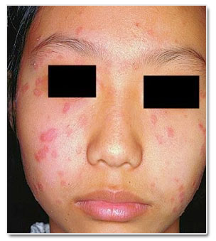 这是一种饲养猫狗等宠物可能会被传染到的皮肤病,原因是由於犬小芽胞