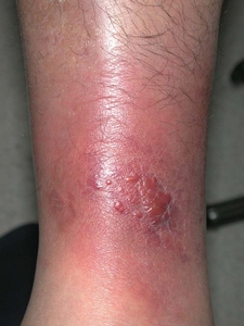 蜂窝组织炎与丹毒