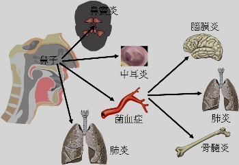 肺炎链球菌毒性强!怎避免宝宝感染?