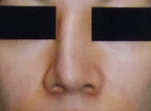 熟女隆鼻歪掉 「鼻整形手术」让她重拾自信