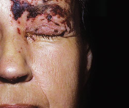 「皮蛇」侵脸易中风,头痛 严重恐失明