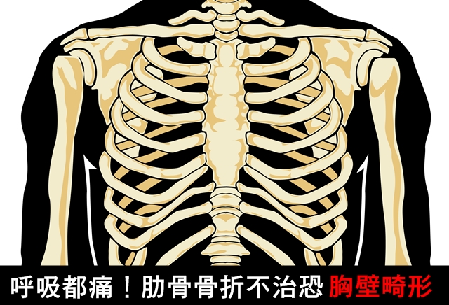 呼吸都痛 肋骨骨折不治恐胸壁畸形 Uho優活健康網