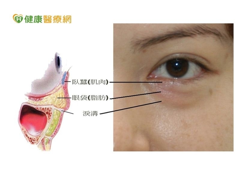 眼袋年齡層降低　過度使用3C產品成誘因