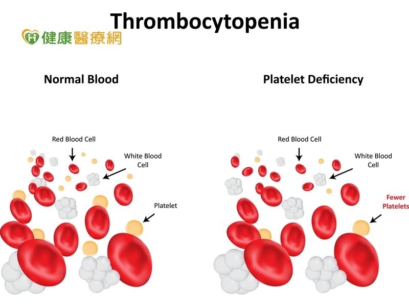 莫名出血點、瘀青！　免疫性血小板低下症恐腦出血