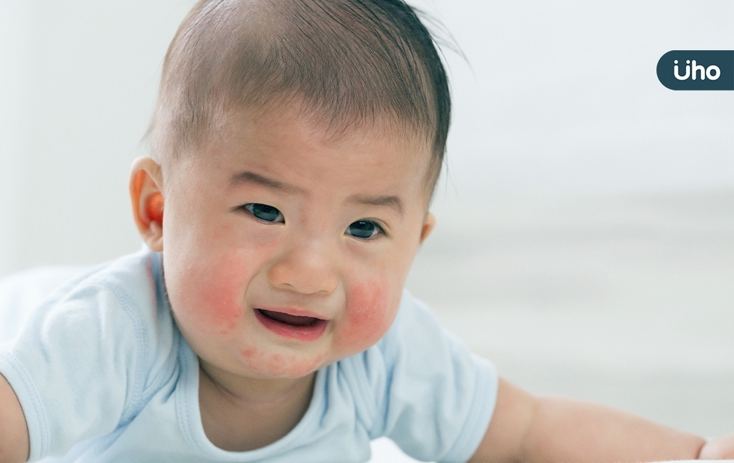 冒紅疹、長痱子⋯嬰幼兒5大「夏季皮膚病」有哪些？醫：這1種會傳染
