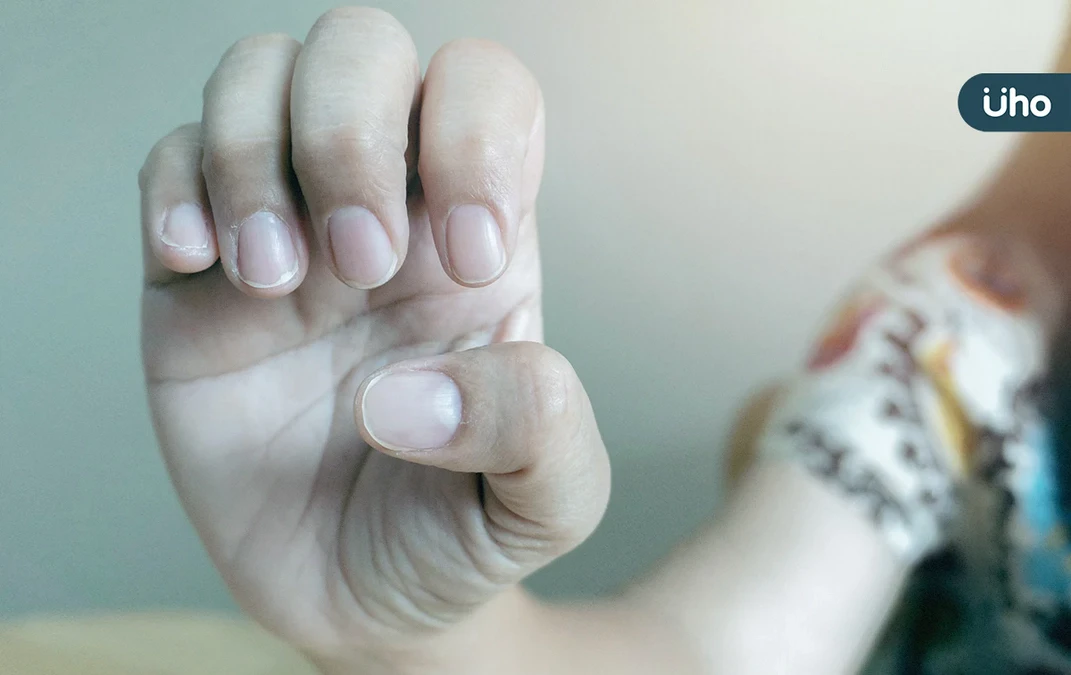 指甲凹陷、變黃正常嗎？指甲「8種變化」洩健康危機：1徵兆恐罹癌