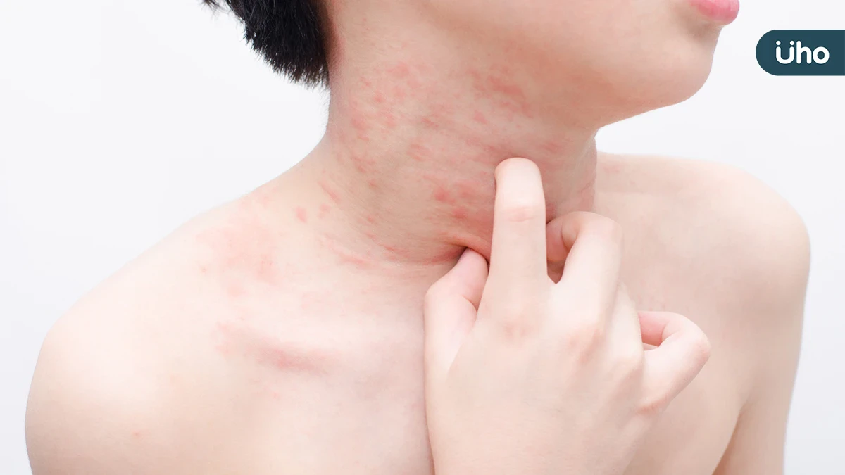 十月一日是世界蕁麻疹日！