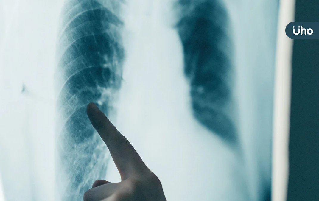 肺腺癌致癌機轉找到了！研究揭「防腐劑、汽機車廢氣」都是元兇之一