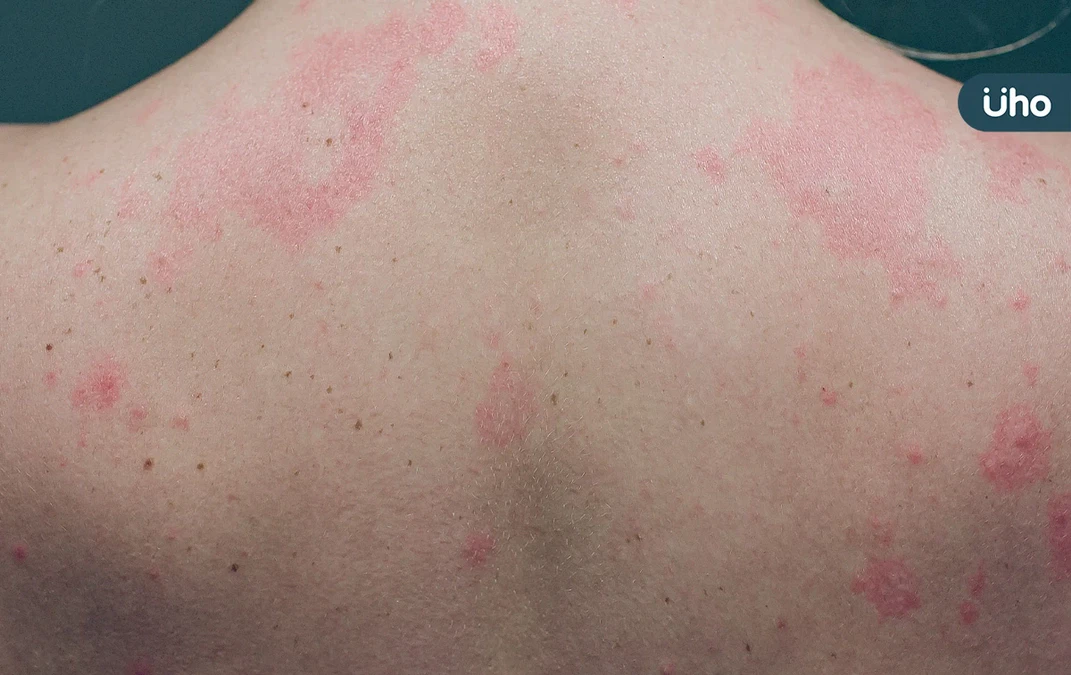 蕁麻疹皮膚癢又腫，不吃藥會自己好？醫揭「這類型」與免疫失調有關