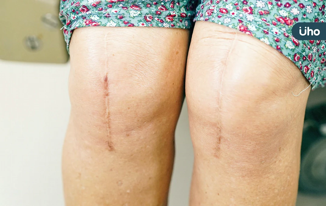 淋巴水腫竟成「大象腿」？醫揭「病程可達數10年」嚴重恐面臨截肢