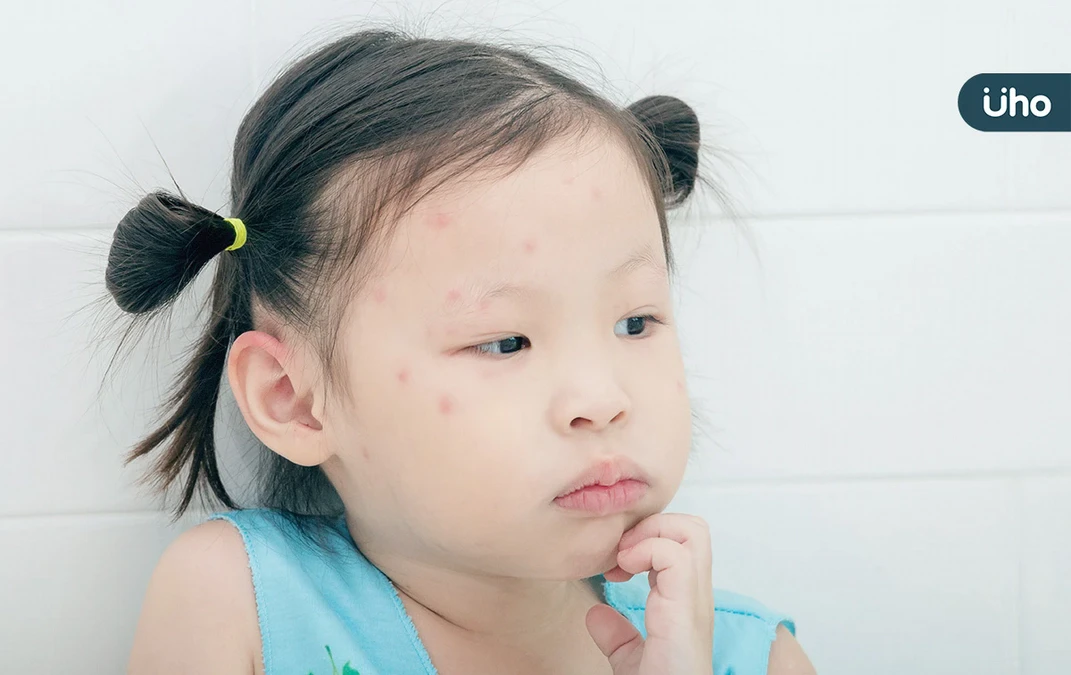 童全身紅疹以為蟲咬，竟是水痘上身！醫警告「成人更嚴重」恐致腦炎