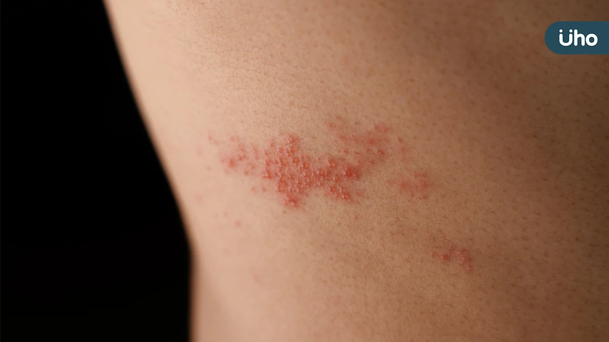 帶狀疱疹後神經痛難纏 中醫4大食療方對症調理