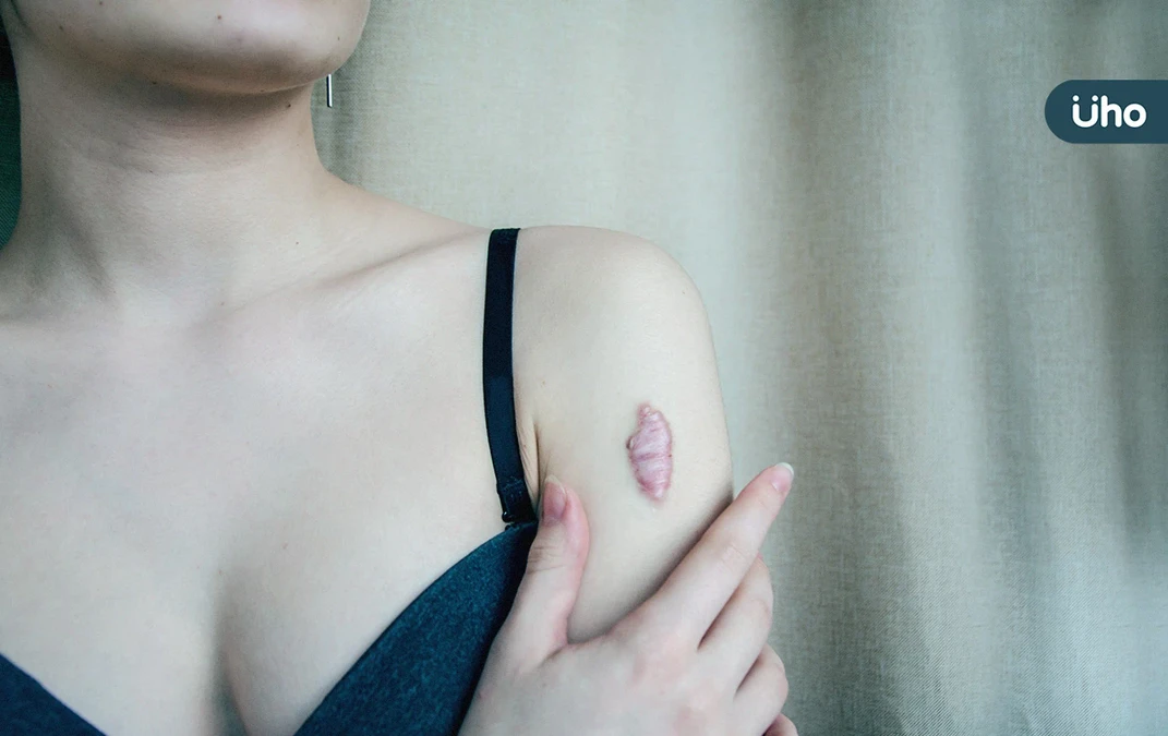 蟹足腫是什麼？醫示警「3情況」恐害皮膚反覆發炎感染：首先別熬夜