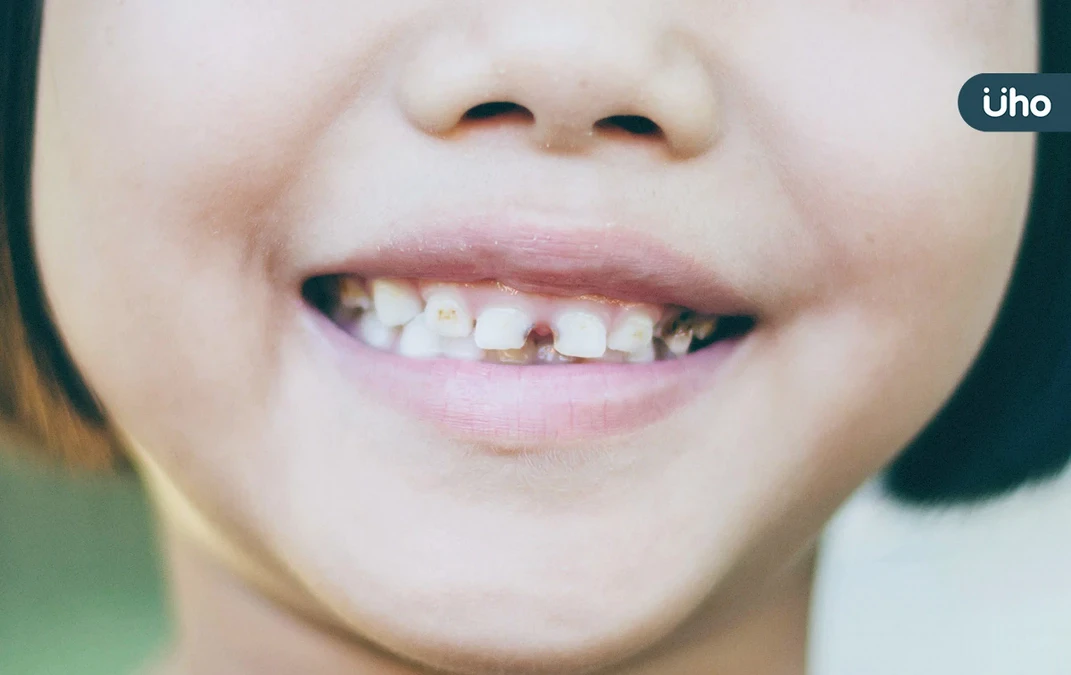 以為孩子門牙歪、蛀牙⋯檢查竟是「多生牙」一定要拔嗎？醫評估5關鍵