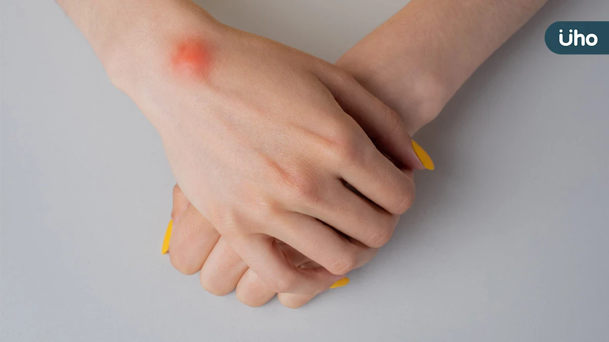 手腕腫塊別輕忽！腱鞘囊腫成因、好發族群與中醫調理重點一次看