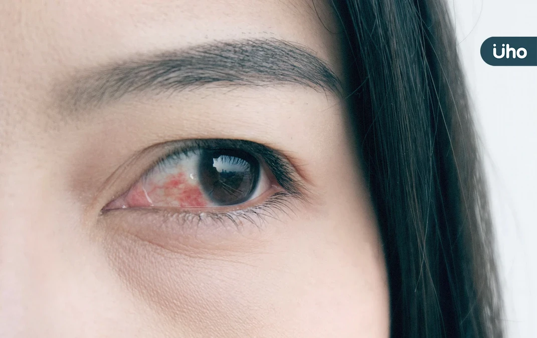 眼睛紅癢不適⋯我是乾眼症還是結膜炎？醫教你分辨兩者差別「1關鍵」