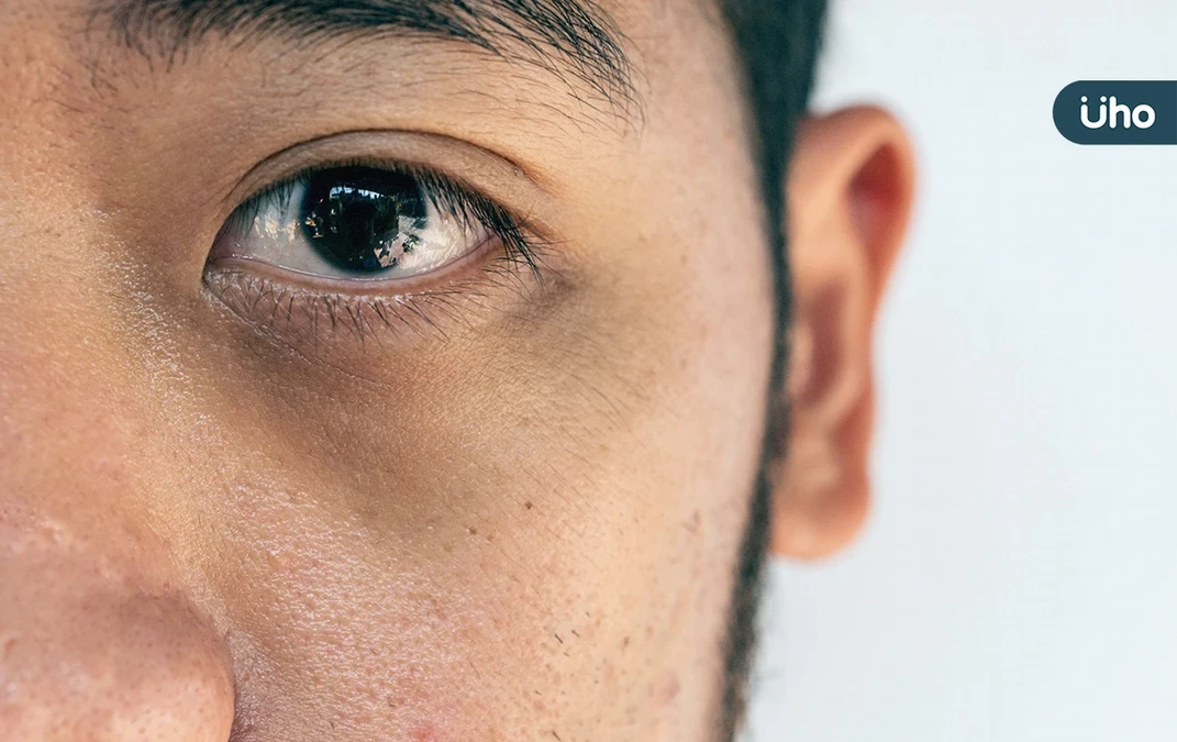 黑眼圈是身體出問題？會自己消？黑眼圈原因、類型、改善方法一次看