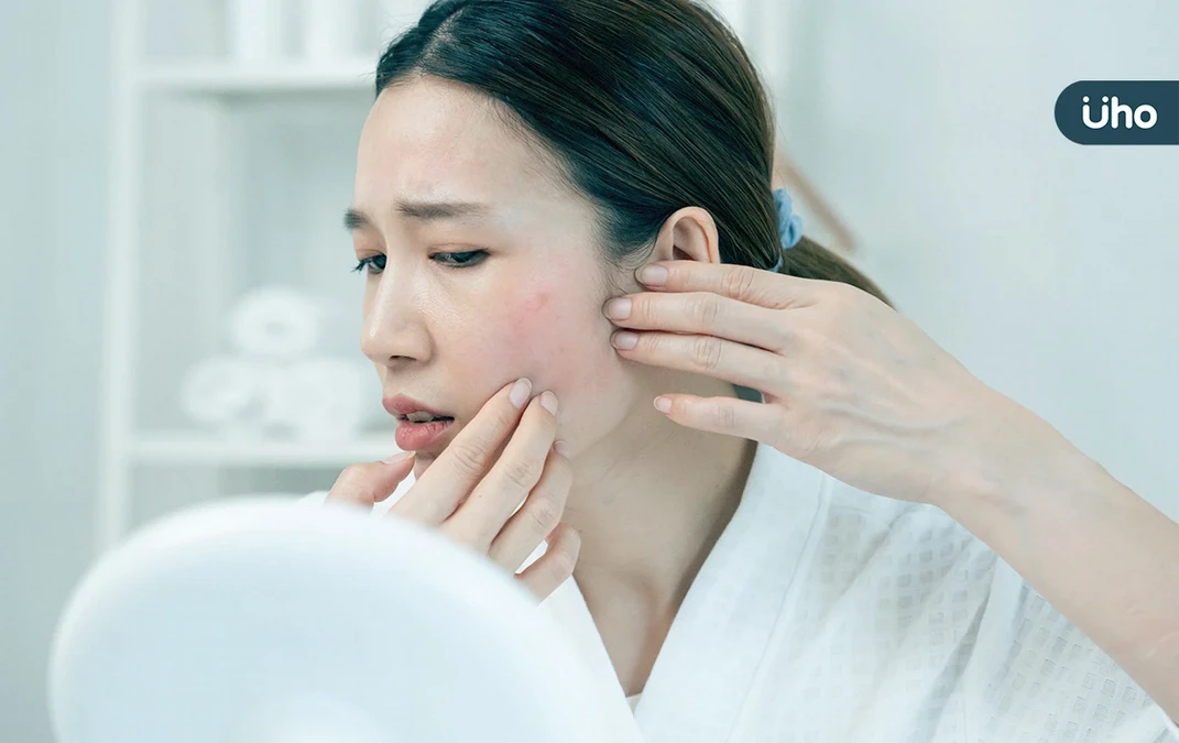 為什麼臉上長滿痘痘？青春痘成因、保養方法一次看：避免過度清潔