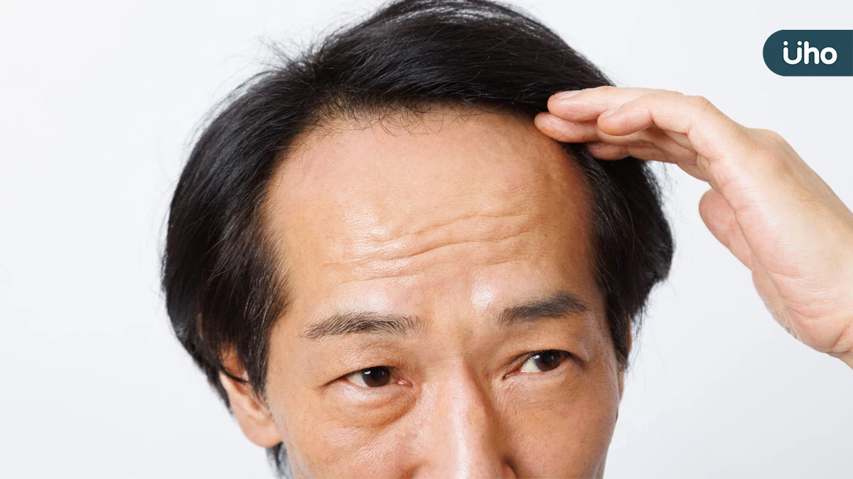 落髮不一定只和荷爾蒙有關 醫：毛囊微環境失衡也可能讓髮量變少