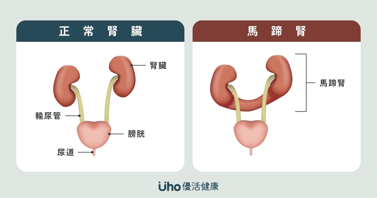 「先天性馬蹄腎」手術風險高