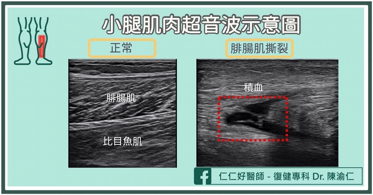 小腿肌肉拉傷、撕裂，該怎麼辦？