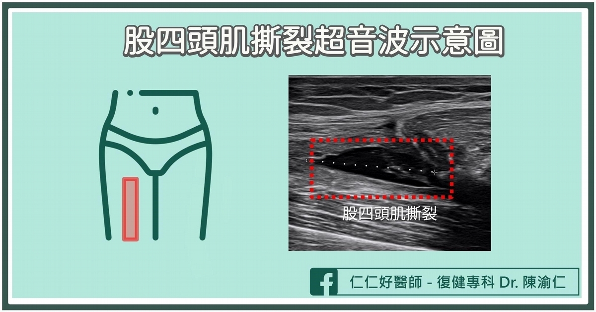 股四頭肌拉傷/撕裂怎麼辦?