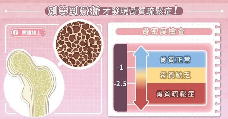 別等到骨折才發現骨質疏鬆症!