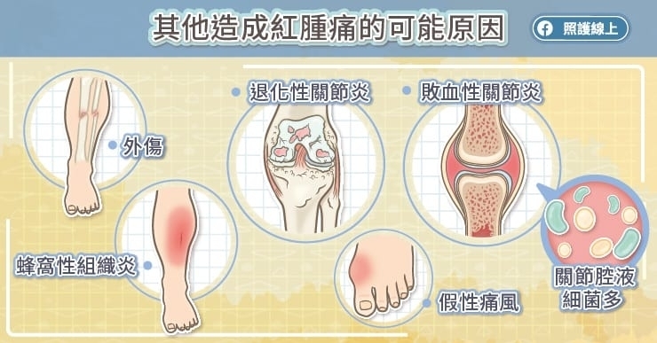會類似痛風發作的幾種狀況