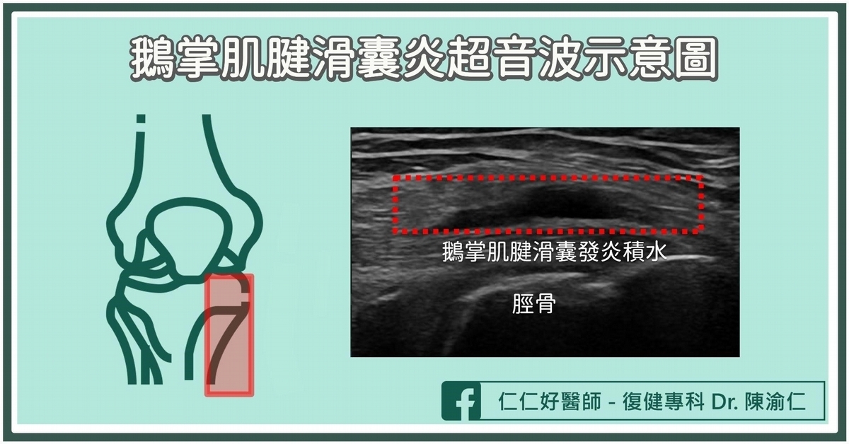 鵝掌肌腱疼痛症候群如何診斷?
