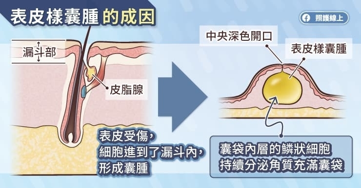 為什麼會長出粉瘤?