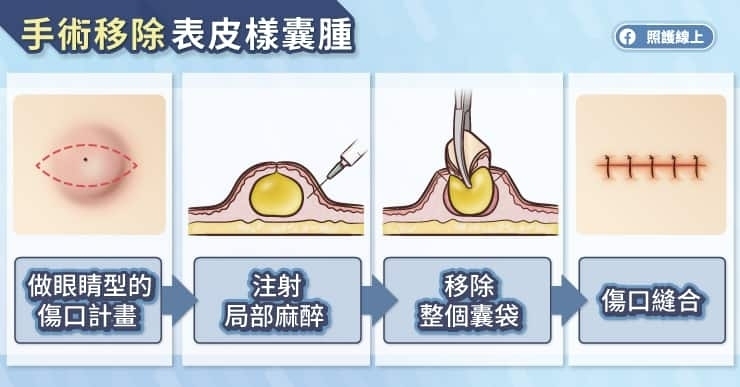 粉瘤需要處理嗎?怎麼處理?