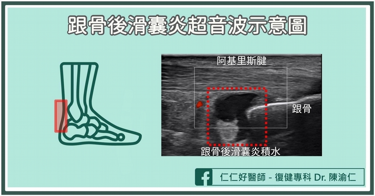 跟骨後滑囊炎的發生原因?