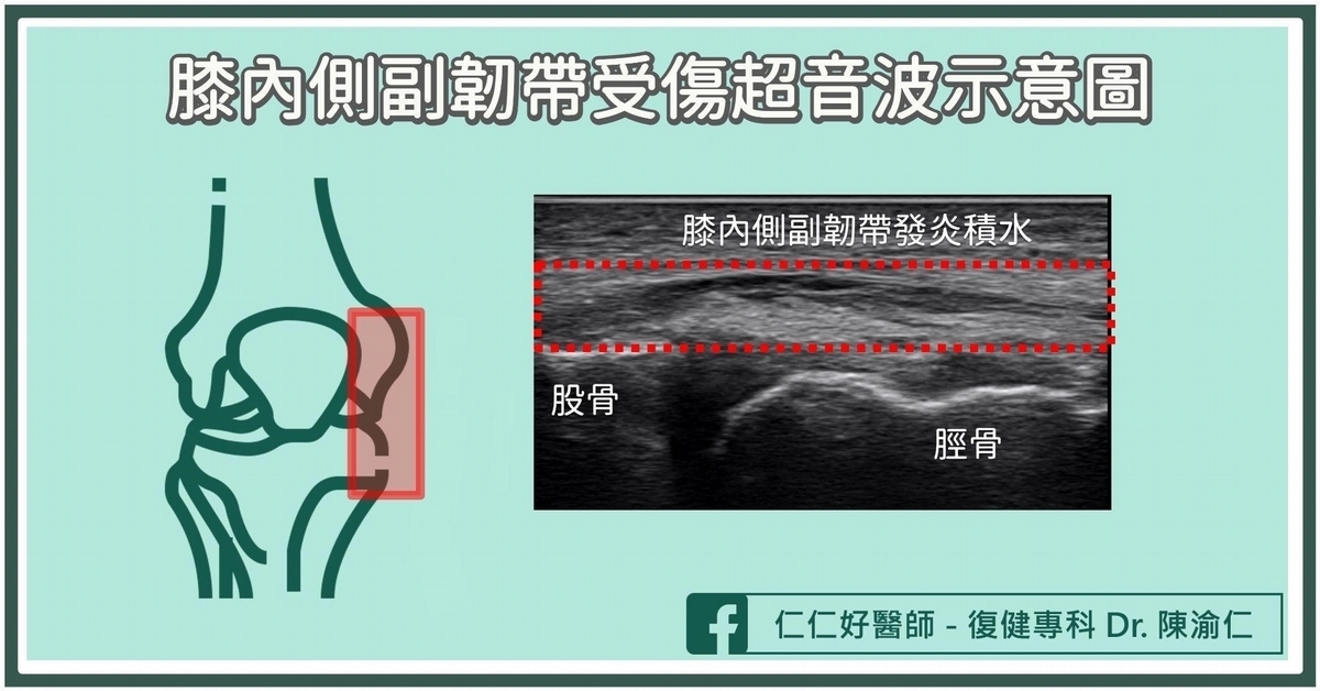 膝內側副韌帶受傷的分級?