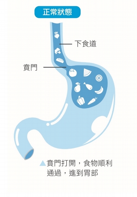 壓力大:腹部加壓,食物被推回食道