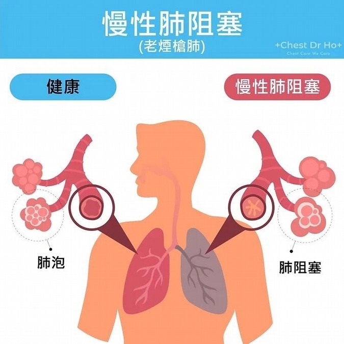 氣喘具可逆性　慢性肺阻塞則為不可逆損傷