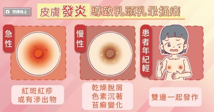 乳頭乳暈皮膚炎