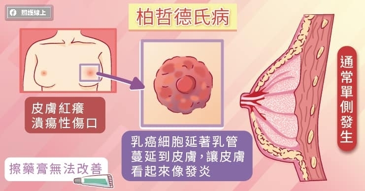 乳頭癢，會是乳癌嗎？