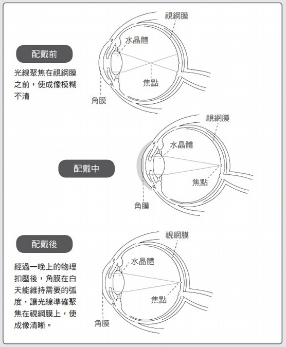 孩子近視了，角膜塑型片真的有效嗎？眼科名醫呂大文這樣解答⋯
