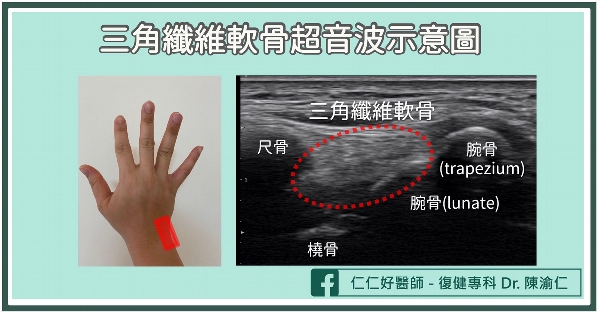 三角纖維軟骨損傷怎麼辦？