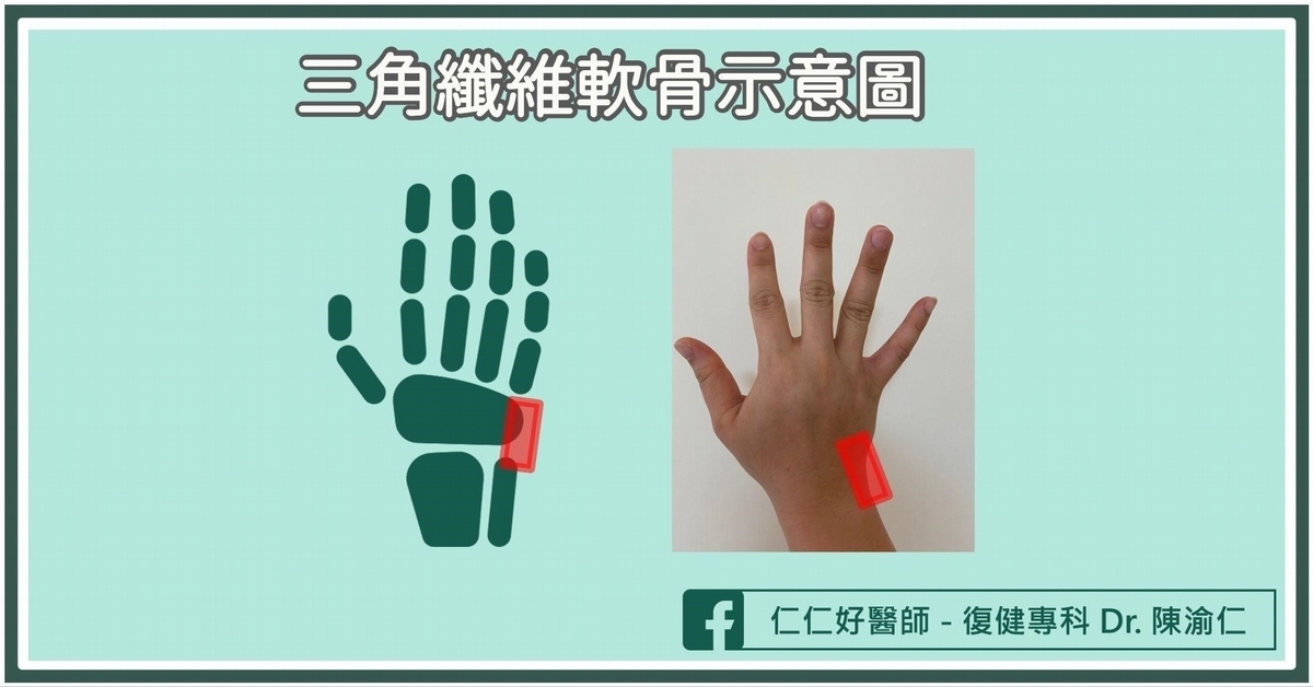 沒有骨折，手腕卻好痛？醫：恐是「三角纖維軟骨損傷」教你2招判斷