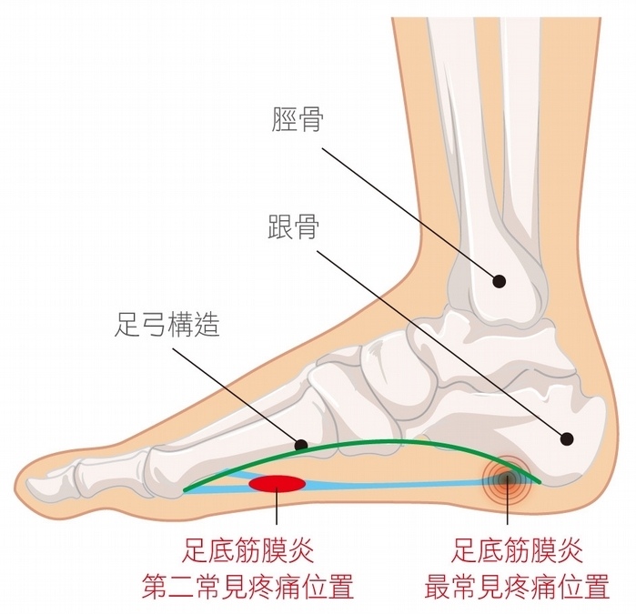 腳底：選對鞋緩衝壓力