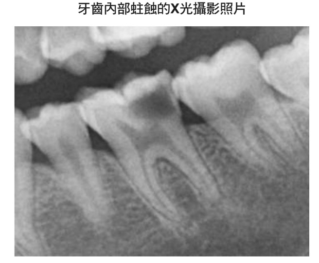 蛀牙也會由內而外