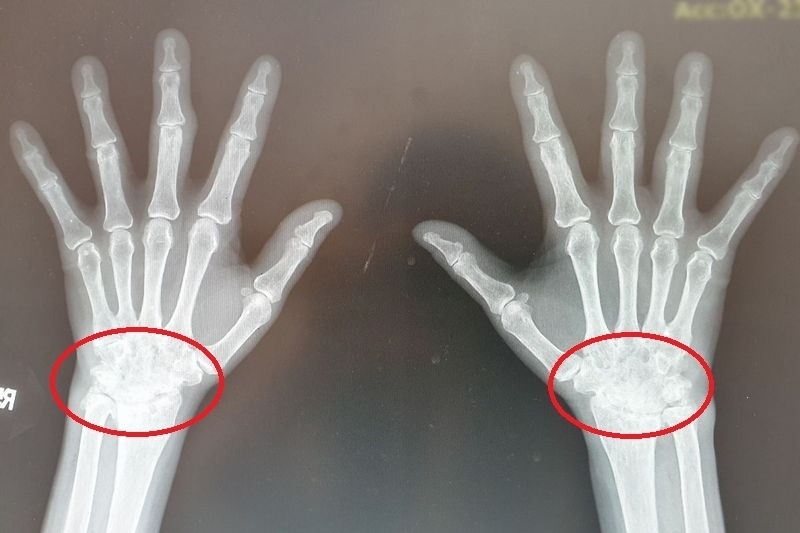 手腕腫痛又無力？小心「類風濕性關節炎」嚴重恐肌腱斷裂、關節變形