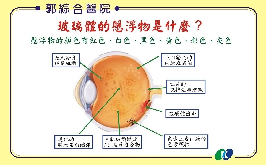 眼睛飄黑影、閃光⋯小心飛蚊症「恐1成視網膜剝離」醫教3招救眼