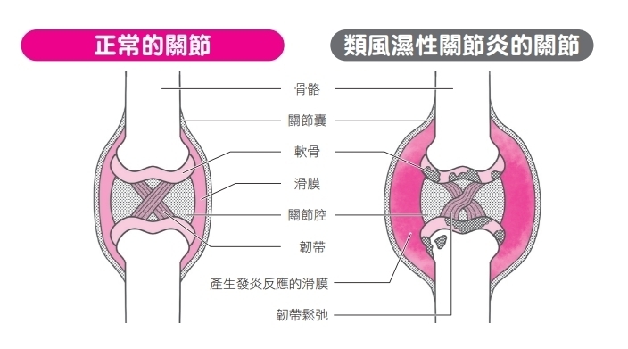 造成關節腫脹、疼痛的原因是什麼？