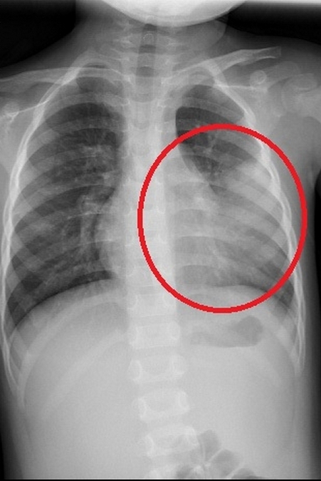 不只RSV、腸病毒⋯家長注意「1病毒」兇猛來襲！醫警：嚴重恐腦炎